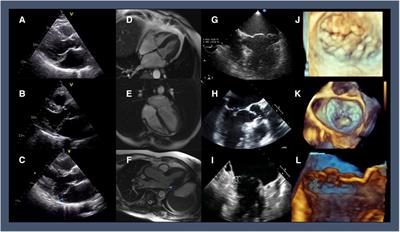 Watchful surgery in asymptomatic mitral valve prolapse